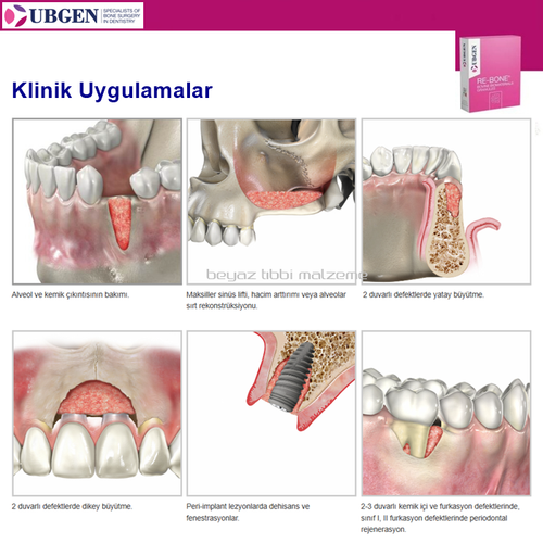 UBGEN Cortico-Can. Kal�n 1-2mm. 5 gr. 12 cc KAMPANYA 10+1 Adet