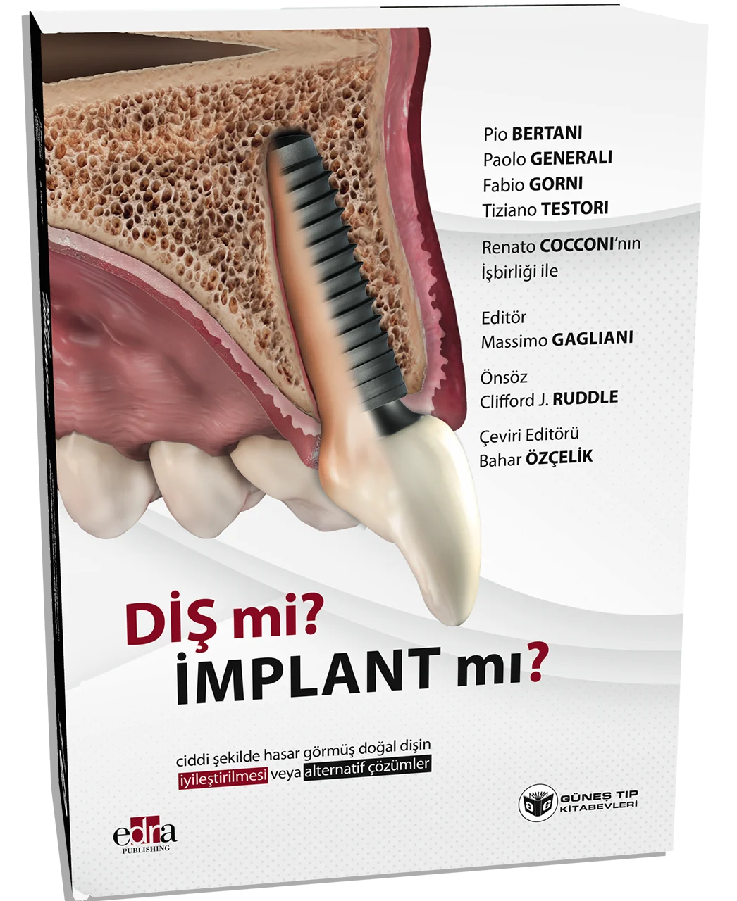 Diş mi? İmplant mı? (Doğal Dişin Korunması veya İmplant Çözümleri Üzerine Kapsamlı Rehber) (Bahar Özçelik)