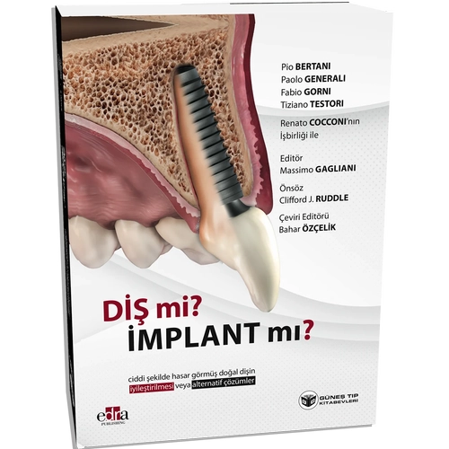 Di� mi? �mplant m�? (Do�al Di�in Korunmas� veya �mplant ��z�mleri �zerine Kapsaml� Rehber) (Bahar �z�elik)