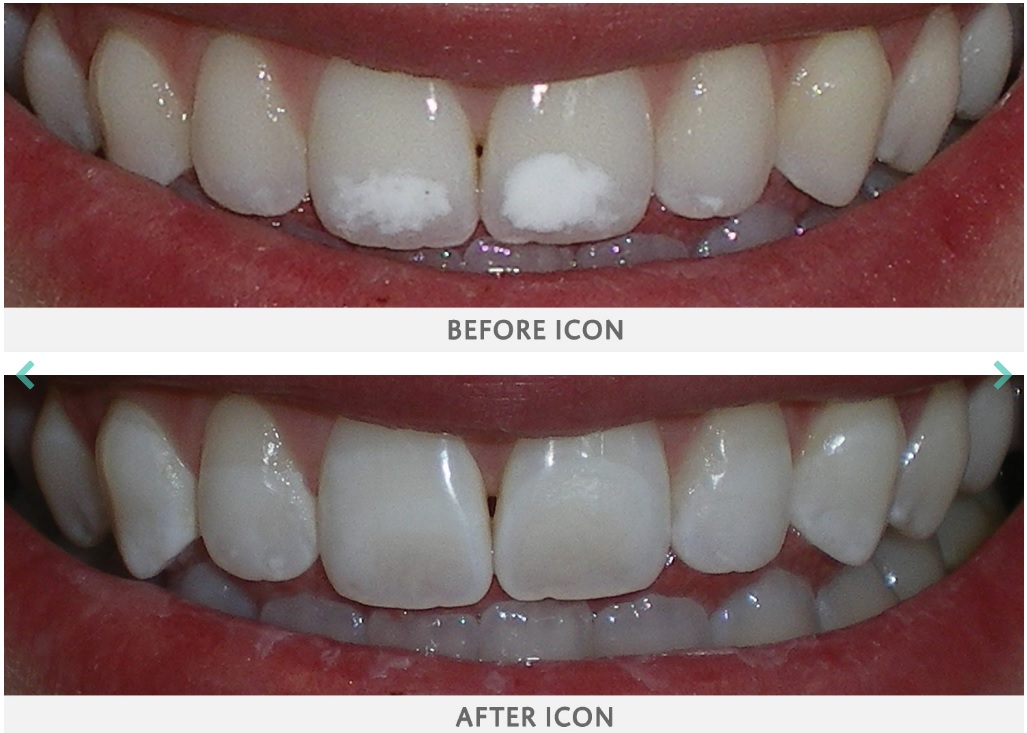 Icon Vestibular Tedavi Sonucu