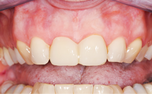 DMG Luxatemp Star Automix