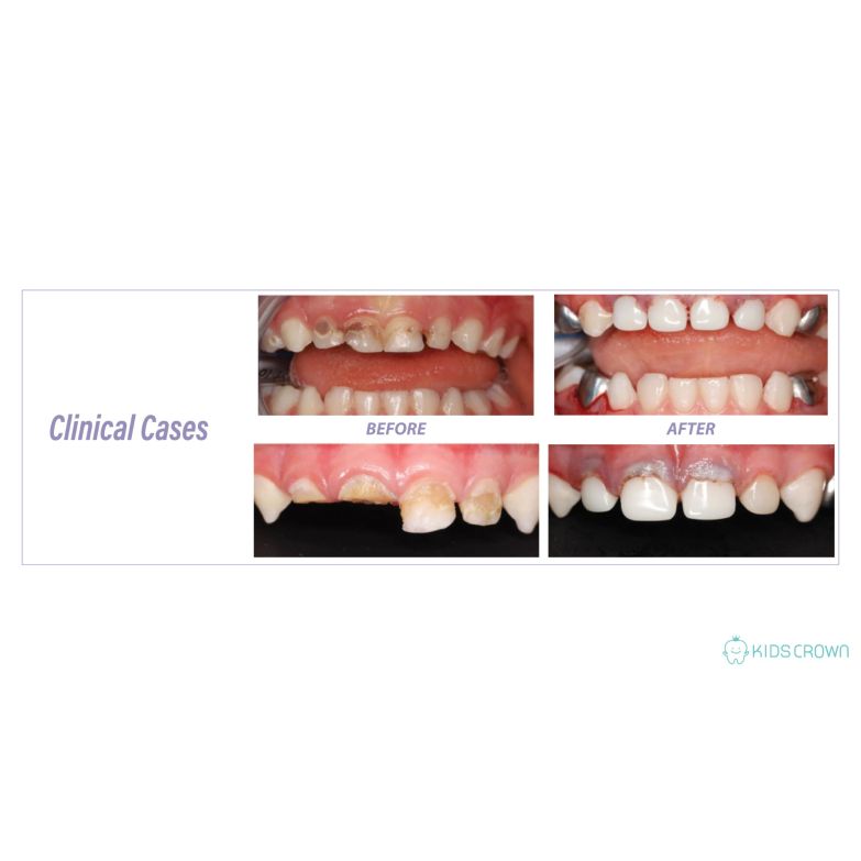 Crown Deck 5色セット KIDS CROWN - Kids Zirconia Crown - Pediatrik Zirkonyum Krom