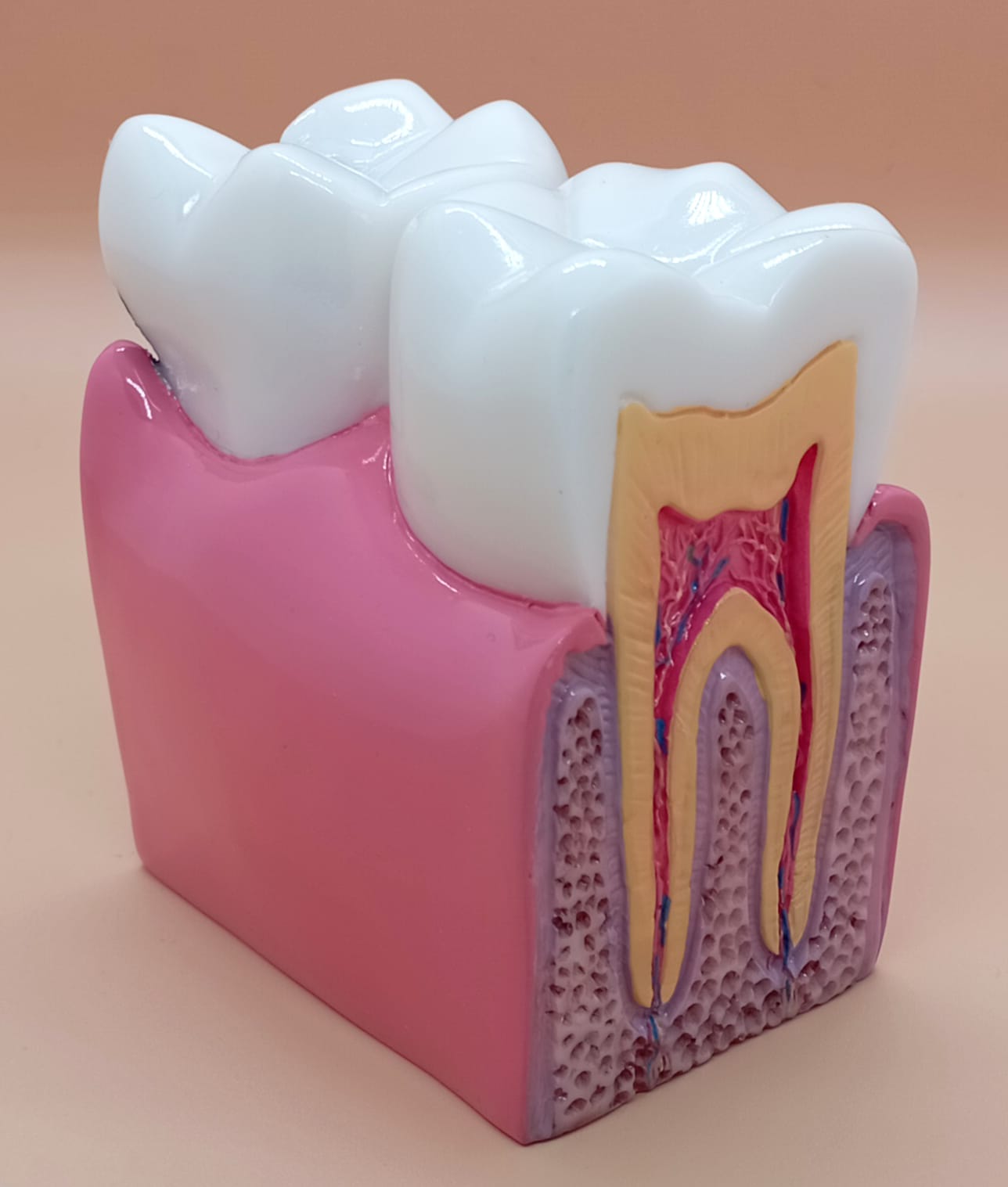 DENTALSEPET Model 4 Patolojik Tek Diş Modeli