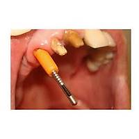 Fibersite Koronal Morfoloji Rekonstruksiyonu in Cam Fiber Sistemi Refill ( 10 Lu )