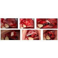 Hypro- Oss ALMANYA 3 cc Greft - ( Partik�l b�y�kl���: 0,5 - 1,0mm)