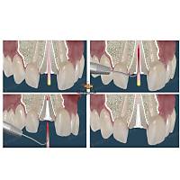 ANGELUS Splendor-SAP Fiber Post Refil Ayarlanabilir Post (5 post + 5 post d paras)