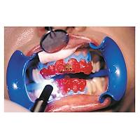 SCHUTZ / MANI DENTAL Bleach N Smile Automix Ofis Tipi Beyazlatma