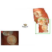 RUNYES 3DS Intraoral Scanner A��z ��i Taray�c�