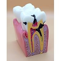DENTALSEPET Model 4 Patolojik Tek Di� Modeli