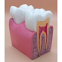 DENTALSEPET Model 4 Patolojik Tek Di� Modeli