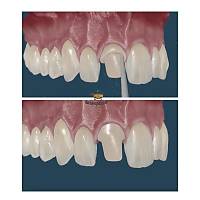 ANGELUS Splendor-SAP Fiber Post Refil Ayarlanabilir Post (5 post + 5 post d paras)