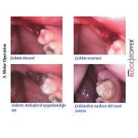 ANKAFERD Blood Stopper Kanama Durdurucu 0,5 ml + ORC Membran - Dental Form Kullan�ma Haz�r Enjekt�r ( Sipari� Tel : +90 552 127 66 63 )