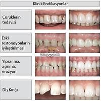 COLTENE WHALEDENT Componeer Kompozit Veneer Mini Set