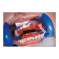 SCHUTZ / MANI DENTAL Bleach N Smile Automix Ofis Tipi Beyazlatma