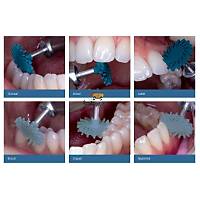 KURARAY Clearfil Twist Dia Kompozit Cila D�ski Trial Kit - 1204-IP