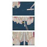 ANGELUS Splendor-SAP Fiber Post Refil Ayarlanabilir Post (5 post + 5 post d paras)