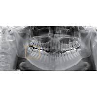 Volux9 3D Dental CT Tomografi