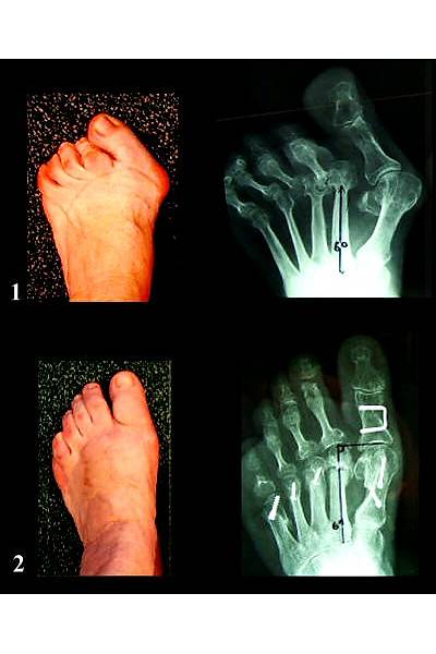 Halluks Valgus ve Topuk Dikeni Hastaları İçin Ortopedik Ayakkabı Erkek EPTHLX51