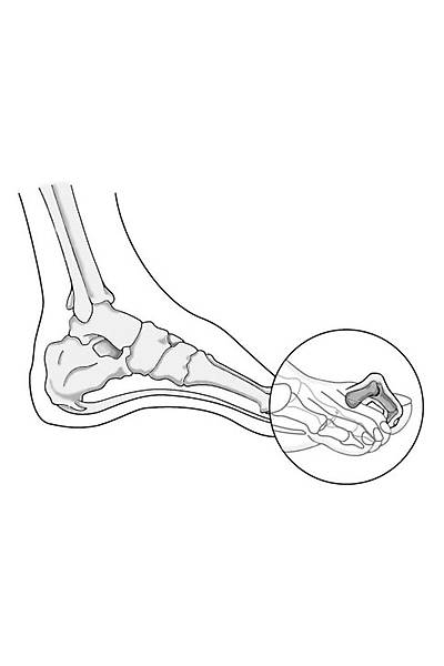 Halluks Valgus ve Topuk Dikeni Hastaları İçin Ortopedik Ayakkabı Erkek EPTHLX51