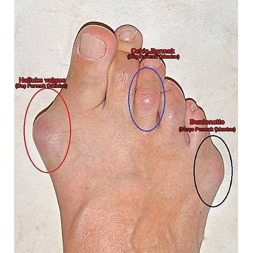 Bayan Topuk Dikeni ve Halluks Valgus Ayakkabs� EPTHLX01