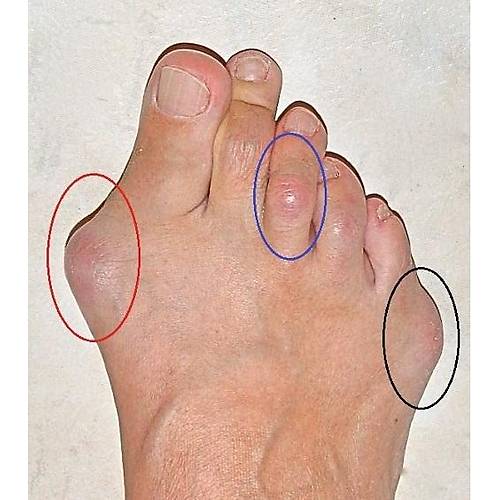 Halluks Valgus ve Topuk Dikeni Ayakkab�s� Erkek EPTHLX51