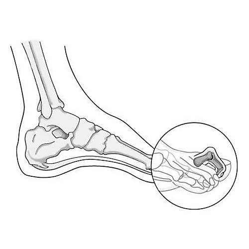 Halluks Valgus ve Topuk Dikeni Ayakkab�s� Erkek EPTHLX51