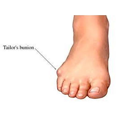 Halluks Valgus İçin Ortopedik Ayakkabı Erkek HLX53S