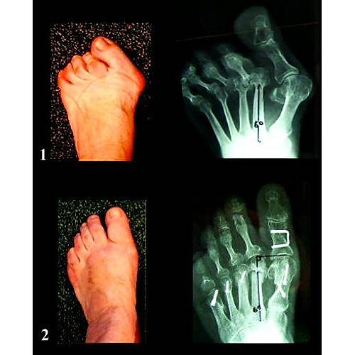 Halluks Valgus İçin Ortopedik Ayakkabı Erkek HLX53S