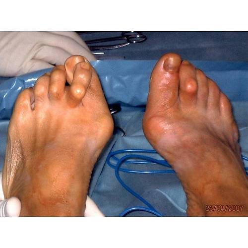 Halluks Valgus İçin Ortopedik Ayakkabı Erkek HLX53S