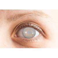 EYE FX - KATARAKT  �ift   LENS