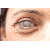 EYE FX - KATARAKT  �ift   LENS